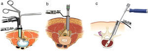 Procedimientos mínimamente invasivos en raquis lumbar. a) Discectomía mínimamente invasiva. b) Laminectomía mínimamente invasiva. c) TLIF miniinvasivo.