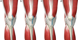 Abordajes miniinvasivos de la rodilla. a) Pararrotuliano medial, reduciendo la longitud de la vía clásica e incidiendo mínimamente el tendón cuadricipital en la inserción del tendón del vasto interno. b) Mid-vastus, penetrando unos 2cm a través del vientre muscular del vasto interno. c) Sub-vastus, levantando el vasto interno. d) quad-sparing, sin alterar las estructuras tendinosas del aparato cuadricipital.