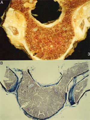 Corte axial de la vértebra T3 de la muestra B. Histológico (A) y microscópico (B) (tricrómico de Masson, ×4), donde se pueden observar islotes de cartílago neurocentral.