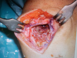 Imagen intraoperatoria. Cavidad en la patela tras el curetaje y la fenolización, previa al relleno con injerto autólogo del paciente.