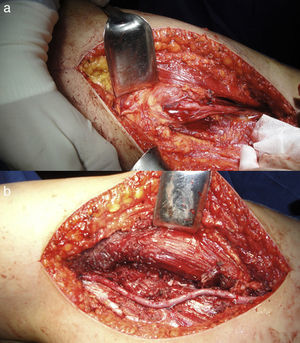 Sarcoma sinovial del muslo. a) Detalle intraoperatorio de la lesión sobre paquete vascular femoral. b) Imagen de la resección y reconstrucción vascular con safena contralateral.