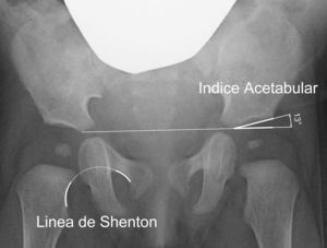 Radiografía anteroposterior de pelvis. La línea de Shenton (cadera derecha) es la medida más utilizada para valorar la relación del acetábulo y el fémur proximal. El índice acetabular (cadera izquierda) es la medida más utilizada para valorar la morfología del acetábulo.