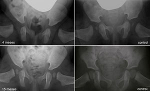 Displasia residual tras el tratamiento con el arnés de Pavlik. La imagen del cuadrante superior izquierdo muestra una radiografía anteroposterior de pelvis de un paciente de 4 meses de edad al inició del tratamiento con el arnés. La imagen del cuandrante inferior izquierdo muestra una radiografía anteroposterior de pelvis del mismo paciente a los 15 meses de edad donde se observa una displasia acetabular residual a pesar del tratamiento con el arnés de Pavlik. Las imágenes de la derecha corresponden a una radiografía anteroposterior de una pelvis normal a los 4 meses de edad en el caso del cuadrante superior derecho, y a los 15 meses de edad en el caso del cuadrante inferior derecho.