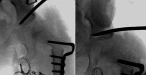 Imágenes correspondientes a una displasia de cadera residual tratada con una osteotomía femoral varizante y derrotatoria y con una acetabuloplastia tipo Dega.
