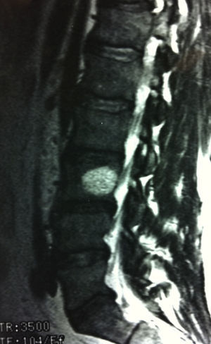 IRM que muestra hernias de Schmorl a nivel de L3 en la paciente con historia de traumatismo.
