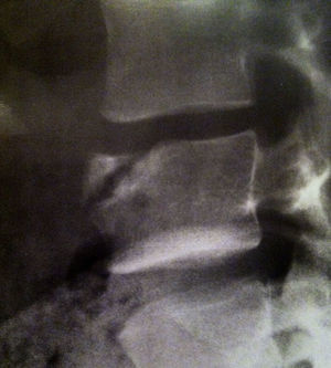 Radiografía que muestra el aumento del diámetro lateral en la proyección radiográfica de L5 (vértebra de Knutsson) en la paciente mujer sin historia de traumatismo.