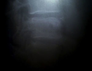 Radiografía que evidencia la falta de desprendimiento o solución de continuidad en el vértice superior vertebral a nivel de L4.