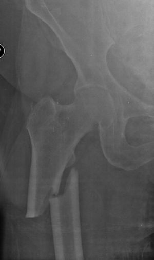 Radiografía de un caso de fractura subtrocantérea de fémur.