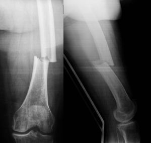 Radiografía de un caso de fractura diafisaria de femur.