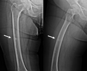 Radiografía de fractura incompleta diafisaria femoral; afectación de la cortical lateral.