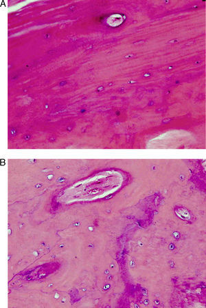 A y B) Biopsia intraoperatoria del foco de fractura. Tinción con hematoxilina-eosina a 2×. Se observa una disminución en el número de osteocitos y cierta desorganización en la estructura tisular.