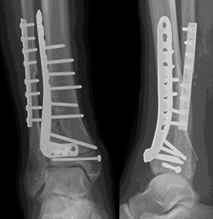 Visión anteroposterior y lateral de fractura de pilón tibial tratada mediante reducción abierta y osteosíntesis con placa anterolateral.