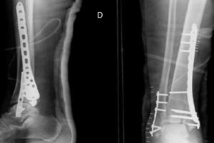 Vision anteroposterior y lateral de fractura de pilón tibial tratada mediante reducción abierta y osteosíntesis con placa anteromedial.