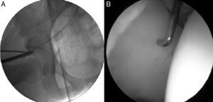 A) Imagen intraoperatoria de radioscopía con el palpador artroscópico mostrando la zona de sobrecobertura-retroversión acetabular; B) visión artroscópica muestra la relación del mismo palpador con la zona condral delaminada.