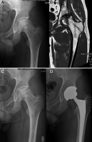 Necrosis cefálica extensa Ficat II en un paciente de 36 años. Rx preoperatoria anteroposterior (A) y RMN (B) de la cadera izquierda. Evolución hacia el colapso a los 23 meses (C) y rescate con una artroplastia total de cadera (D).