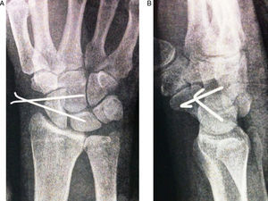 A y B) Imagen radiológica postoperatoria inmediata.