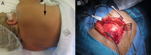 Imagen clínica (A) y quirúrgica (B) de un elastofibroma dorsi.