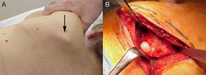 Imagen clínica (A) y quirúrgica (B) de un osteocondroma de escápula.