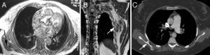 A y B) Resonancia magnética mostrando un elastofibroma dorsi. C) Tomografía axial mostrando un osteocondroma de escápula.