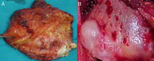 Muestras anatomopatológicas resecadas de elastofibroma dorsi (A) y osteocondroma de escápula (B).