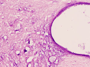 Imagen de una neurona altamente eosinofílica con daño medular (H&E ×10, 12μ).
