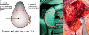 Defecto óseo glenoideo. A) Medición del defecto. B) Reconstrucción 3D TAC defecto óseo glenoideo. C) Técnica de Latarjet.
