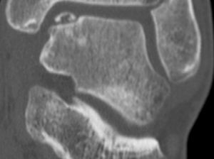 Lesión OC grado IV en el ángulo anteromedial del astrágalo. La radiografía simple es la primera prueba de imagen a tener en cuenta en el diagnóstico de las lesiones osteocondrales.