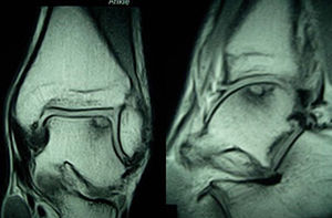 Lesión OC grado II. En la RM, se objetiva la lesión del ángulo anterolateral con edema óseo subcondral e integridad de la superficie articular.
