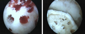 Imagen artroscópica de perforaciones separadas 4 mm entre sí, hasta que se produce el sangrado del lecho subcondral que estimula la producción de fibrocartílago en el defecto.