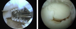 Desbridamiento de la lesión OC y reconstrucción del defecto con un cilindro osteocondral en una lesión grado IV de la vertiente medial.