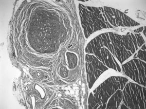 Desarrollo de la estructura nerviosa con signos de regeneración y abundante tejido conectivo perineural a la izquierda, apoyado sobre un bloque de músculo. Tricrómico de Masson (×5).