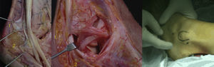 Relaciones anatómicas de los tendones peroneos. 1: RPS; 2: RPI. Fuente: cortesía del Dr. X. Martín Oliva.