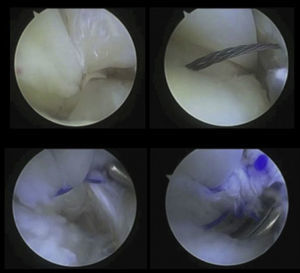 Rotura longitudinal del tendón PB. Reparación tendoscópica con 3 suturas de nylon 2/0 empleando un pasador Mini Suture Lasso de Arthrex®.