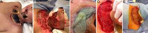 Paciente con secuelas de mordedura de Loxosceles laeta. A) Condición inicial de la herida. B) Posterior a desbridamiento. C) Con aplicación del sistema VAC®. D) Condición de la herida posterior a 3 aplicaciones. E) Resultado final, herida con injerto cutáneo.