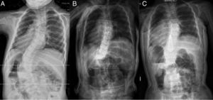 A) Radiografía PA de una niña de 3+9 diagnosticada de escoliosis de aparición precoz idiopática con curva toracolumbar izquierda de 60°. B) Tras la colocación del primer corsé de yeso derrotatorio la curva ha disminuido hasta los 35°. C) La paciente tiene ahora 5+11 y la curva 28°.