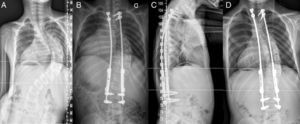 A) Radiografía PA de un niño de 6+9 diagnosticado de escoliosis de aparición precoz idiopática con curva toracolumbar derecha de 106°. B) Tras la colocación de los tallos de crecimiento dobles la curva ha disminuido hasta los 44°. C) El perfil sagital se conserva de manera correcta. D) El paciente tiene 8+4 y tras 3 expansiones la curva presenta 1031°.
