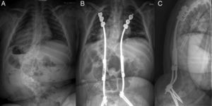 A) Radiografía PA de una niña de 6+1 diagnosticada de escoliosis de aparición precoz de origen neuromuscular con curva toracolumbar izquierda de 80°. B) Tras varios desanclajes de ganchos proximales se optó por reconvertir el montaje en un sistema híbrido. C) El perfil sagital se conserva adecuadamente.