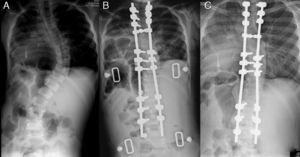 A) Radiografía PA de un paciente con escoliosis de aparición precoz de origen idiopático. B) Radiografía postoperatoria con la corrección obtenida. C) En el último seguimiento se mantiene en gran medida la corrección y se constata el crecimiento de la columna vertebral por el deslizamiento de las barras en el interior de los tornillos deslizantes. (Cortesía del Dr. David Skaggs).