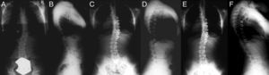 A) Radiografía PA de un paciente de 12+0 diagnosticada de escoliosis idiopática con una curva torácica derecha de 29°. B) Radiografía lateral con una cifosis torácica de 15°. C) Radiografía postoperatoria con una corrección inicial hasta los 19°. D) Proyección lateral constatándose la correcta colocación de las grapas. E) Proyección PA transcurridos 4+1 desde la cirugía con una curva de 17°. F) Proyección lateral en la que se aprecia una cifosis de 28°. (Cortesía del Dr. Randal Betz).