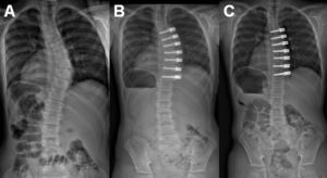 A) Radiografía PA de un paciente de 10+0 diagnosticado de escoliosis idiopática que presenta una curva torácica derecha de 42°. B) Radiografía postoperatoria con la corrección obtenida y una curva de 28°. C) Dieciocho meses después la curva ha disminuido hasta los 14°. (Cortesía del Dr. Peter Newton).