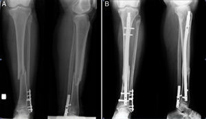 A) Fractura diafisaria de tibia. Se observa material de osteosíntesis de peroné distal con fractura consolidada. B) Seis meses desde el postoperatorio.