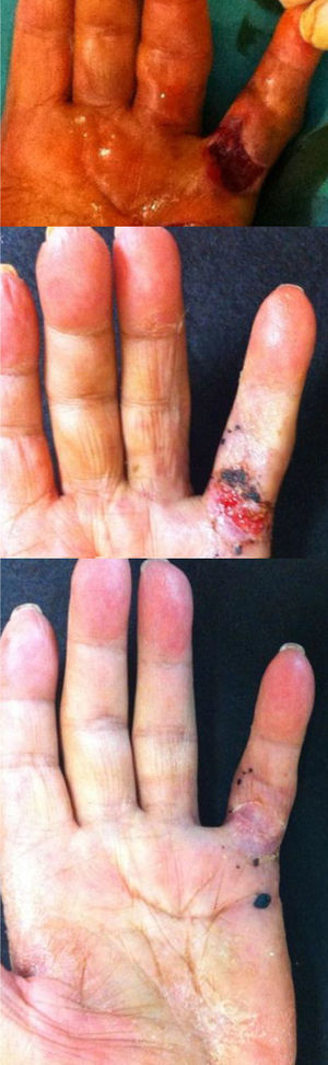 Dehiscencia de piel tras estiramiento dedo, a los 15 y a los 25 días (cura por segunda intención).