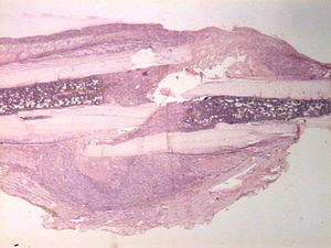 Aspecto microscópico del callo de fractura en una muestra estudiada.