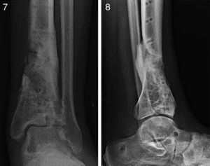 A y B) Resultado tras la retirada de material de osteosíntesis y distracción articular, mantenimiento de interlínea articular a los 14 meses.