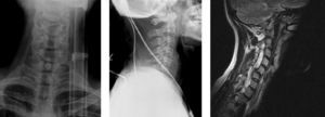 Radiografía AP y lateral de columna cervical el día del accidente de tráfico. RM realizada posteriormente en su mutua, en donde se ve la luxación de una carilla articular y la subluxación de la otra entre C5-C6 y se valora el componente discal.