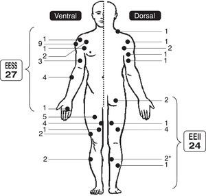 Representación esquemática de la distribución de los 51 casos de la serie en el cuerpo.*En un mismo paciente hubo un lipoma intramuscular en cada gemelo interno de sus pantorrillas.