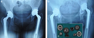 a) Control radiográfico (año 2005) con separación del componente reticular de ambas copas y líneas de radiolucencia en las zonas acetabulares i y ii, sin sintomatolgía clínica. b) Control radiográfico (año 2012), que evidencia movilización bilateral de la copa acetabular sin luxación con un desplazamiento. Obsérvese la separación del componente poroso acetabular. c) Componentes movilizados y retirados.