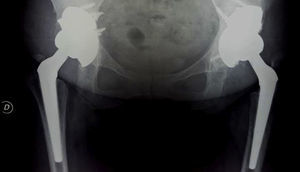 Control radiográfico al año, que evidencia un correcto posicionamiento de los implantes con restauraciòn de los centros de rotaciones.