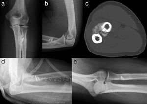 En las imágenes (a) y (b) se muestran las radiografías anteroposterior y lateral, y en la (c) la TAC donde se aprecia la sinostosis generada tras la implantación de arpones para la reinserción del tendón del bíceps. En la línea inferior se muestra la radiografía postoperatoria (d), y al año (e) con ausencia de la sinostosis.
