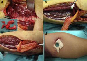 En la imagen (a) se aprecia la sinostosis (en pequeño los fragmentos de la sinostosis), y en la (b) el colgajo disecado con la arteria interósea posterior y la perforante septal. En la imagen (b) se ve el colgajo evertido para interponerlo en la zona de la sinostosis, y en la (d) el anclaje cutáneo anterior que estabiliza el colgajo.